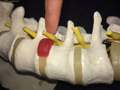 symptoms of l5 nerve compression